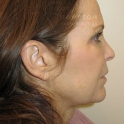 FACELIFT | FAT INJECTIONS – 784