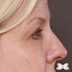 Upper/Lower Blepharoplasty with Peri-Orbital Fat Injections by: Dr. Thompson