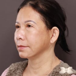 Facelift and Browlift by: Dr. Thompson