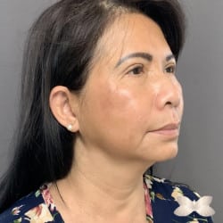 Facelift and Browlift by: Dr. Thompson