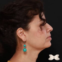 Facelift, Upper Eyelid Lift and Full Face Fat Grafting by: Dr. Thompson