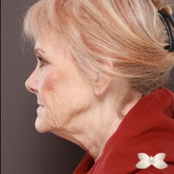 Facelift and Lower Eyelid Lift by: Dr. Thompson