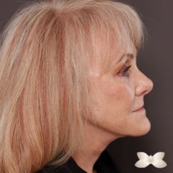 Facelift and Lower Eyelid Lift by: Dr. Thompson