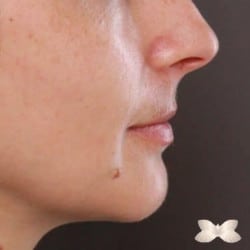 Chin Implant by: Dr. Henstrom