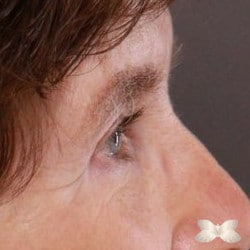 Upper/Lower Eyelid Lift and Peri-Orbital Fat Injections by: Dr. Thompson