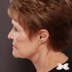 Facelift by: Dr. Thompson