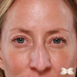 Upper Eyelid Lift and Lower Skin Pinch by: Dr. Henstrom