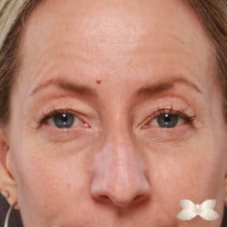 Upper Eyelid Lift and Lower Skin Pinch by: Dr. Henstrom