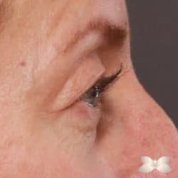 Upper Eyelid Lift and Lower Skin Pinch by: Dr. Henstrom