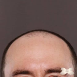 FUT Hair Transplant by: Dr. Thompson