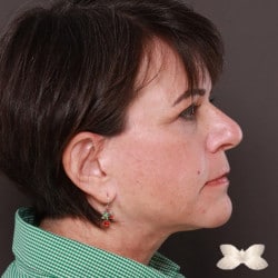 Facelift, Lower Eyelid Lift and Peri-Orbital Fat Injections by: Dr. Thompson
