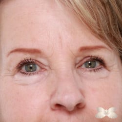 Upper Eyelid Lift by: Dr. Henstrom