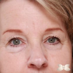 Upper Eyelid Lift by: Dr. Henstrom