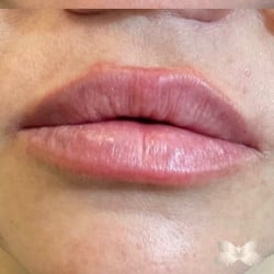 Aumento de labios mediante enfermera inyectora