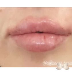 Aumento de labios por: Alfie