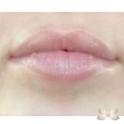 Lip Augmentation by: Alfie