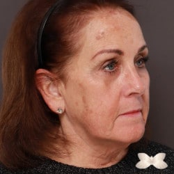 Facelift, Upper Eyelid Lift, Peri-Orbital Fat Injections by: Dr. Thompson