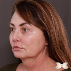 Facelift by Dr. Thompson