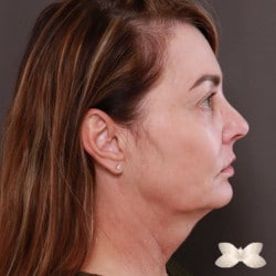 Facelift by Dr. Thompson