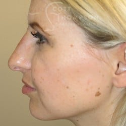Non-Surgical Rhinoplasty by Dr. Scott Thompson