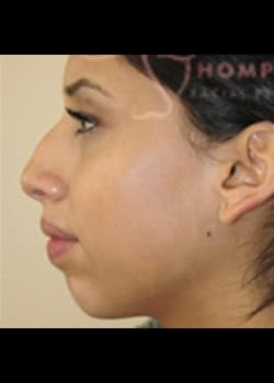 Rhinoplasty/Chin Augmentation Patient 07