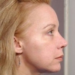 Rhinoplasty Revision by Dr. Thompson