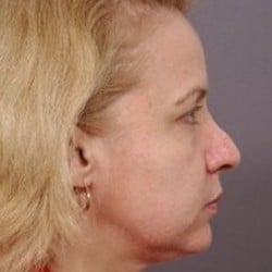 Rhinoplasty Revision by Dr. Thompson