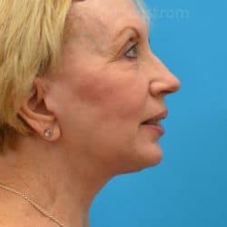 Facelift with Chin Implant – by Dr Henstrom – 914