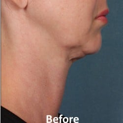 Kybella Before & After Photos | 989