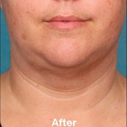 Kybella Before & After Photos | 992