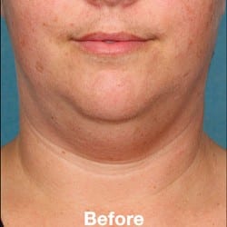 Kybella Before & After Photos | 992