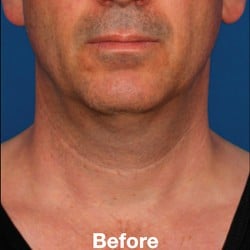Kybella Before & After Photos | 995