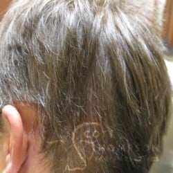 Hair Restoration Utah Patient 333