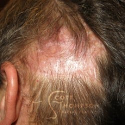 Hair Restoration Utah Patient 333
