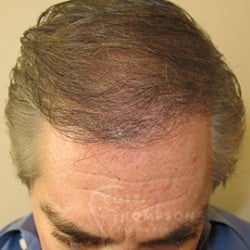 Hair Transplant FUT Method by Dr. Thompson