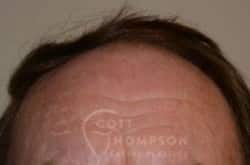 Hair Transplant Surgery – Neograft by Dr Thompson – 905