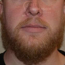 Beard Hair Transplant by Dr. Thompson