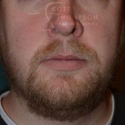 Beard Hair Transplant by Dr. Thompson