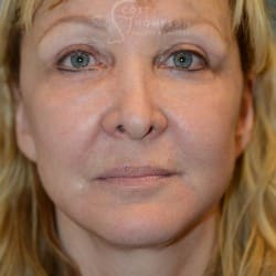 Facelift | Eyelid Surgery | Jowl Implant | CO2 Laser – 823