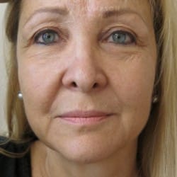 Facelift | Eyelid Surgery | Jowl Implant | CO2 Laser – 823