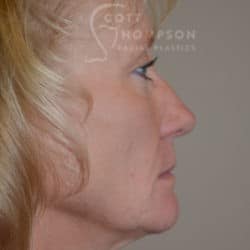 Fractional CO2 Laser Resurfacing – 967