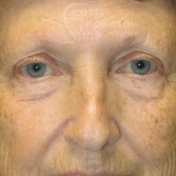 Lower Blepharoplasty (Eyelid Lift) 127