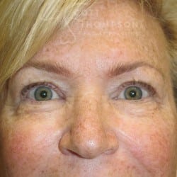 Lower Blepharoplasty (Eyelid Lift) Patient 128