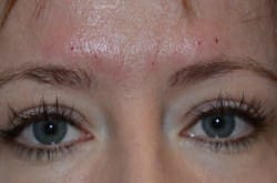 Upper Eyelid Surgery | Lower Eyelid Surgery with Fat Injections – 545