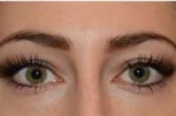 Lower blepharoplasty with fat repositioning by Dr. Thompson – 900