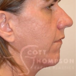 Rhinoplasty/Chin Augmentation Patient