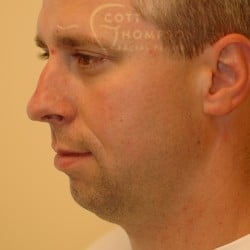Chin Augmentation Before and After Photos 200