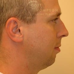 Chin Augmentation Before and After Photos 200