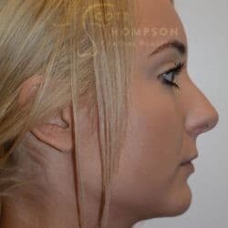 Chin Augmentation & Submental Liposuction by Dr. Thompson – 904