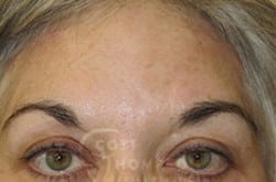 Forehead Lift Before & After Photos 222